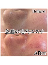 ビューティースタジオ ティー(Tiy)/毛穴洗浄