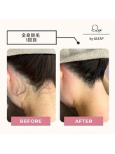 キュオバイアンドリープ(Qo by &LEAP)/全身脱毛ビフォーアフター