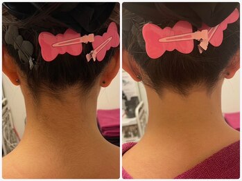 エステサロン ジジ 新宿(JIJI)/ソフトシェービング例2(襟足)