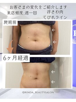 リンダ(Rinda)/ボディフォースカッター（お腹）