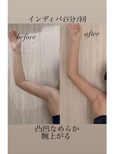 ダウンタイムオンニ(DowntimeOnni)/二の腕ダウンタイムケア