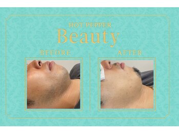 サロンエス 高田神楽店(SALON S)/当サロンのヒゲ症例写真です♪