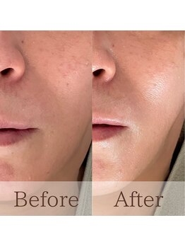 凪眠/たるみ改善ラジオ波フェイシャル