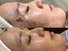 Beauty salon Rucca/ハーブピーリング