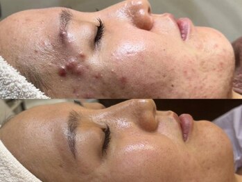 Beauty salon Rucca/ハーブピーリング