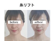 ナネア(Nanea)の雰囲気(切らない糸リフトで理想のフェイスラインへ♪)