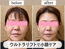 タマ 代官山(TAMA)の雰囲気(【毛穴/シミ/ニキビ/小顔ケア】ウルトラリフトで引き上がる♪)