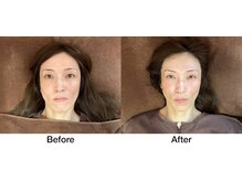 こじま 富雄団地接骨院/たるみ改善・リフトアップ