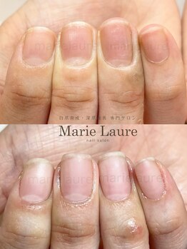 マリーロール 淀屋橋本店(Marie Laure)/自爪育成/深爪矯正/ネイルケア