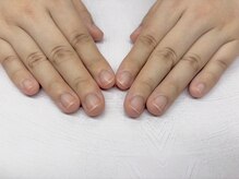 プルーヴ(PROVE)/深爪を防ぐケアの重要性