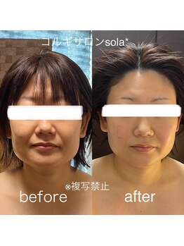ソラ(sola*)/エラ、頬スッキリキュッと小顔