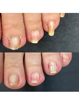 リリ(lili)/巻き爪矯正+ネイルケア1回目