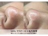 洗浄×引き締め★【黒ずみ除去毛穴レス肌】LHAララピール＋毛穴洗浄 ¥17,500 