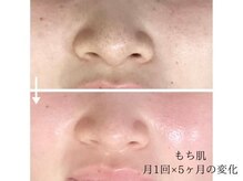 こもれび/吸引なしでも毛穴に変化を実感