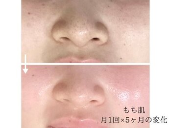 こもれび/吸引なしでも毛穴に変化を実感