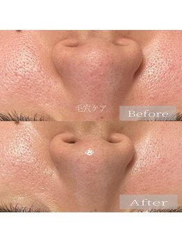 リリールア(Rere-Rua)/ハイドロヴィーナス毛穴洗浄