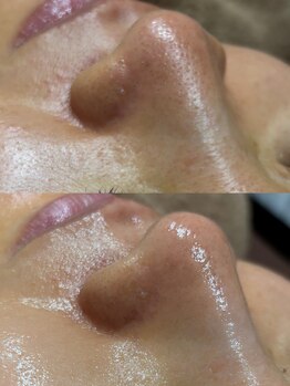 ユウユウ(YUYU)/毛穴洗浄