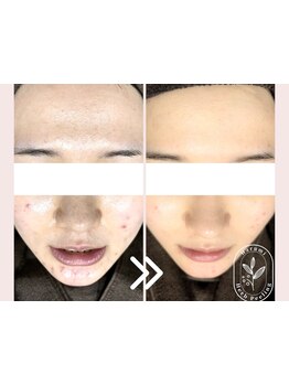 美白ケアをしたい