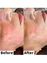 マハロハ 自由が丘(Mahaloha)/【赤み・敏感肌ケア施術】