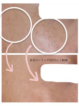 ポノ(PONO)/水光ピーリング