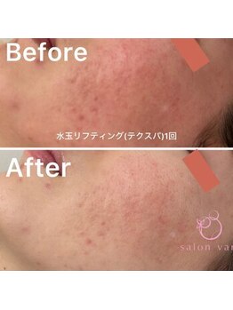 ヴェアリー 広尾(VARY)/頬のニキビや赤みに