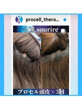 スリール(sourire)/30代女性☆　円形改善施術3回