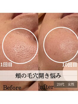 パルティノ 高崎店/メイクすれば余計に目立つ毛穴開