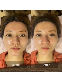 サンサンゴビューティー(335beauty)/リブセラ/施術回数1回