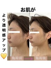 ブルーシー(BLUESEA)/【RHR】幹細胞ハーブピーリング