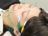 【小顔・美肌】美容鍼 plus + パルス通電 45分◇5310円