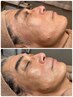 ララピール×ヘッドスパ【リフトアップとターンオーバー促進】睡眠の質向上