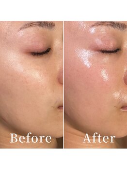 ユカリス(Yu.charis)/水光導入ミコステラBefore/After