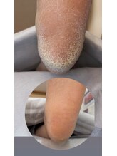 フットミー(foot mii)/かかとの悩みに角質ケアを