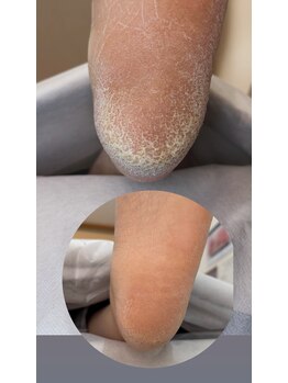 フットミー(foot mii)/かかとの悩みに角質ケアを