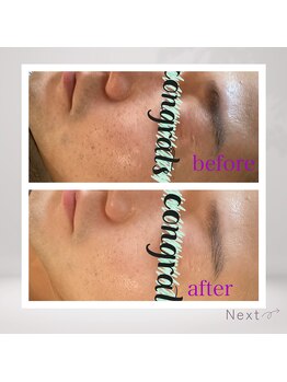 ルシアス(LUCIAS)/ハーブピーリング