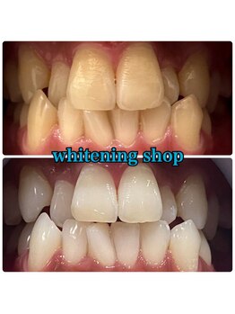 ホワイトニングショップ 盛岡店(WHITENINGSHOP)/初めてのホワイトニング歓迎♪