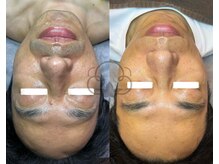 プライベートサロン コットン(COTTON)/肌改善プログラム、髭脱毛