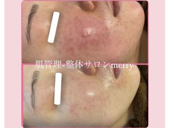 メリー 大和西大寺店(merry)/赤みにお悩みの方に、ニキビケア