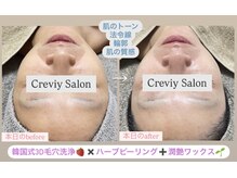 クレヴィー(Creviy)/3D毛穴洗浄×ハーブ×産毛脱毛