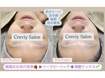 クレヴィー(Creviy)/3D毛穴洗浄×ハーブ×産毛脱毛