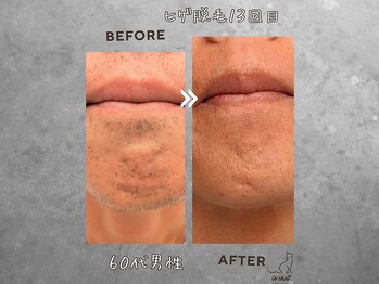 ル シャ/メンズ脱毛/毛穴洗浄/ヘッドスパ