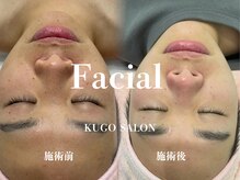 クゴ サロン(KUGO SALON)/水素ピーリング＋光フォト症例