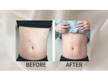 スポットスリム(SPOT SLIM)/【脂肪冷却】モニター様30代男性