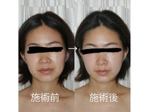 ヘッドリセット 麻布十番/深筋膜ヘッドスパ*筋膜をほぐす