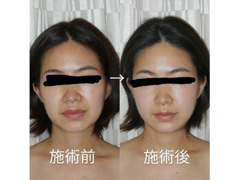 ヘッドリセット 麻布十番/深筋膜ヘッドスパ*筋膜をほぐす