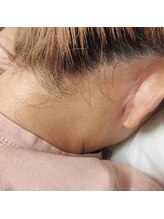 キアラ 麻布十番(Kiara)/うなじ　ブラジリアンワックス