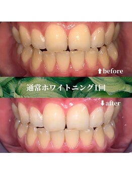 フタバ 天神大名店(futaba)/初回ホワイトニングbefore after