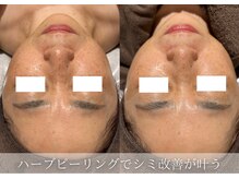 ティアラッシュ(TiaLash)/ハーブピーリング