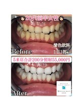 ホワイトニングビューティー 吉祥寺店/症例写真_5回来店されたお客様