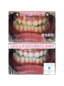 ホワイトニングビューティー 吉祥寺店/症例写真_5回来店されたお客様